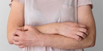 “Effective Strategies for Handling Psoriasis Flare-Ups”