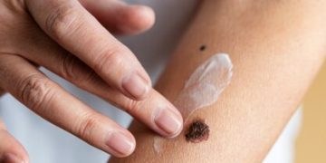 “Effective Strategies for Handling Psoriasis Flare-Ups”