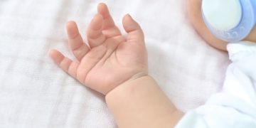 Understanding Neonatal Jaundice: A Closer Look at Hyperbilirubinemia